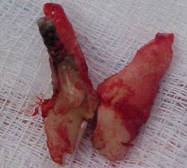 abscess 3 root tooth