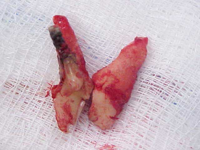 Extracted tooth