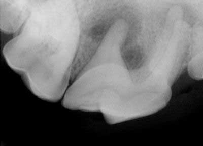 Root abscess